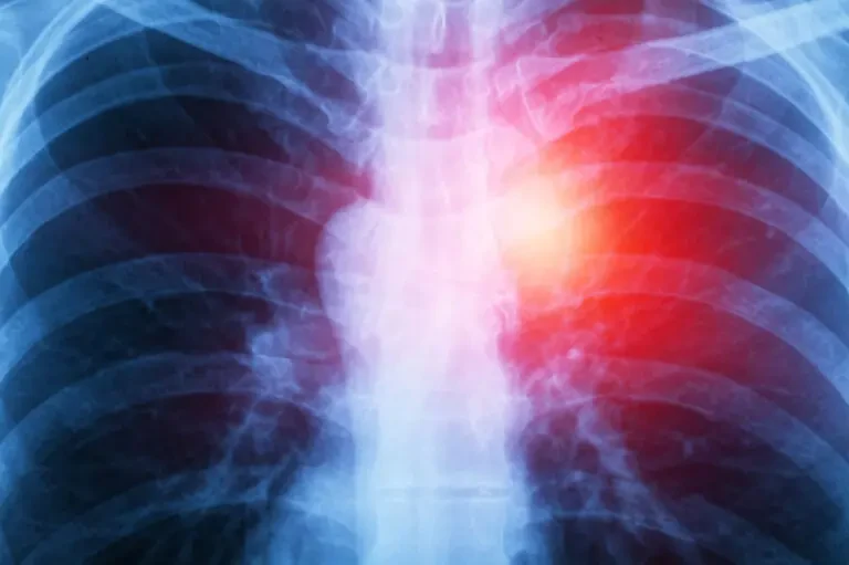 Mesothelioma Lawyer
