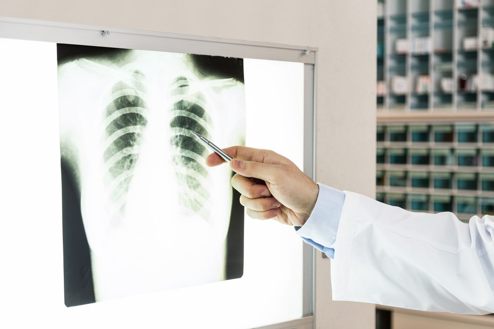 Filing a Mesothelioma Lawsuit: What You Need to Know